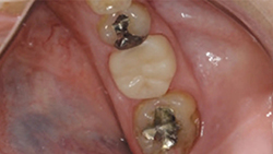 RONDOflex-plus-360_CAD-CAM-crown3_800px.jpg
